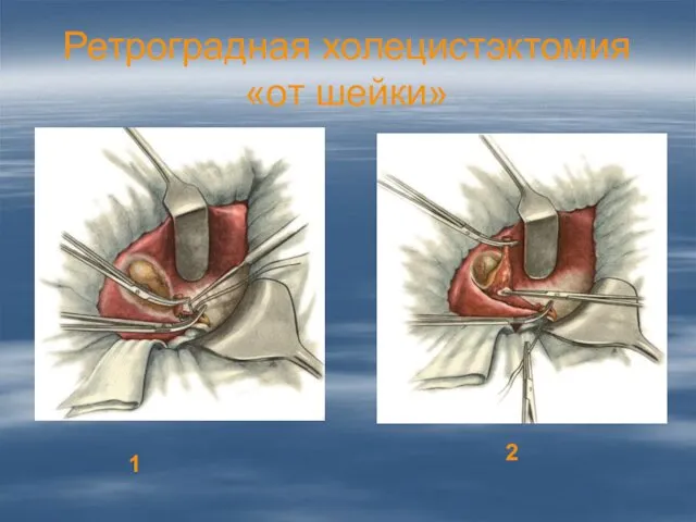 Ретроградная холецистэктомия «от шейки» 1 2