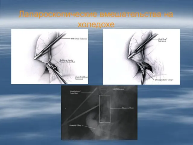Лапароскопические вмешательства на холедохе