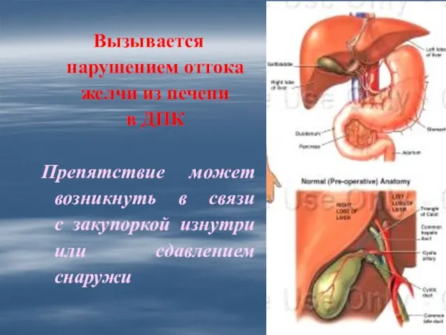 Вызывается нарушением оттока желчи из печени в ДПК Препятствие может