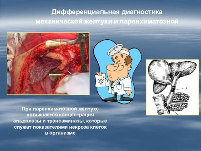 Дифференциальная диагностика механической желтухи и паренхиматозной При паренхиматозной желтухе повышается