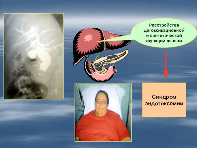 Расстройства детоксикационной и синтетической функции печени Синдром эндотоксемии