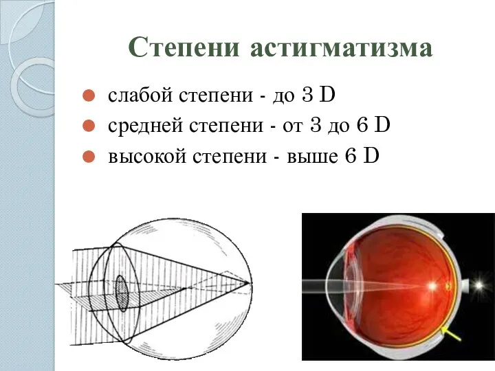 Степени астигматизма слабой степени - до 3 D средней степени