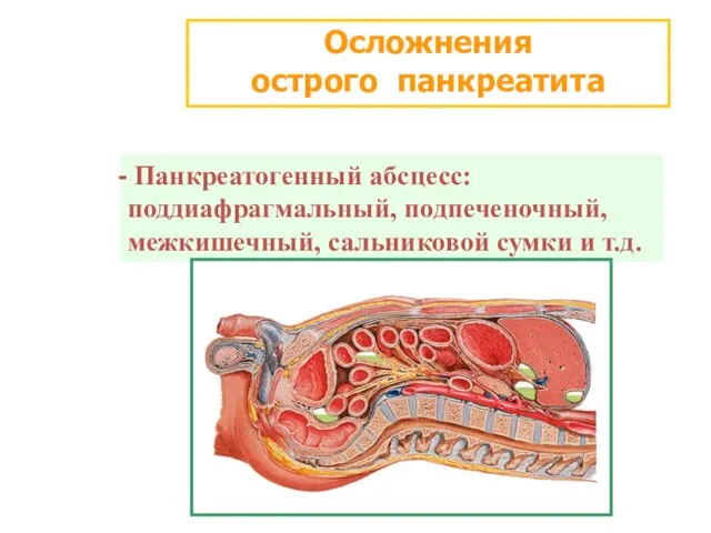 Осложнения острого панкреатита Панкреатогенный абсцесс: поддиафрагмальный, подпеченочный, межкишечный, сальниковой сумки и т.д.