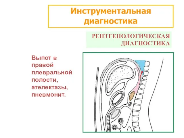 Инструментальная диагностика РЕНТГЕНОЛОГИЧЕСКАЯ ДИАГНОСТИКА Выпот в правой плевральной полости, ателектазы, пневмонит.