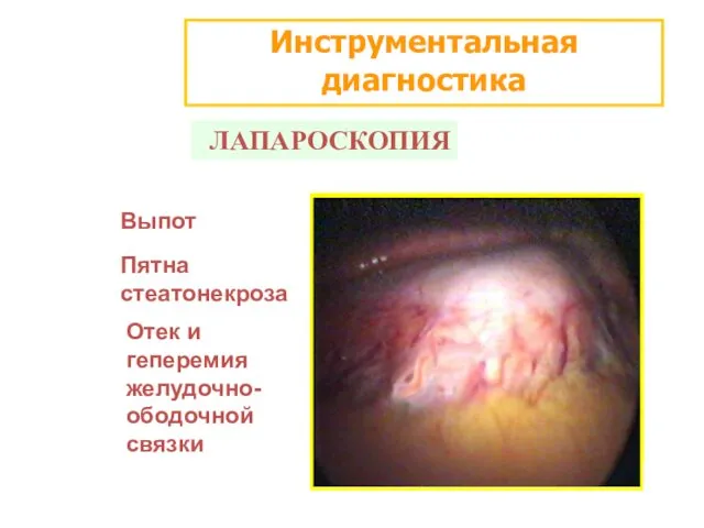 Инструментальная диагностика ЛАПАРОСКОПИЯ Выпот Пятна стеатонекроза Отек и геперемия желудочно-ободочной связки
