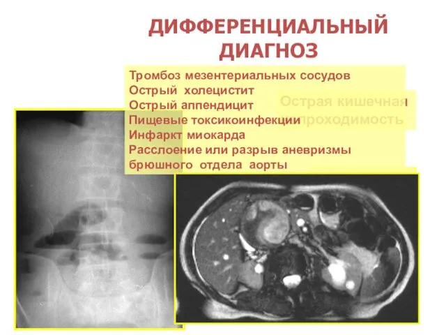 ДИФФЕРЕНЦИАЛЬНЫЙ ДИАГНОЗ Острая кишечная непроходимость Чаши Клойбера Тромбоз мезентериальных сосудов