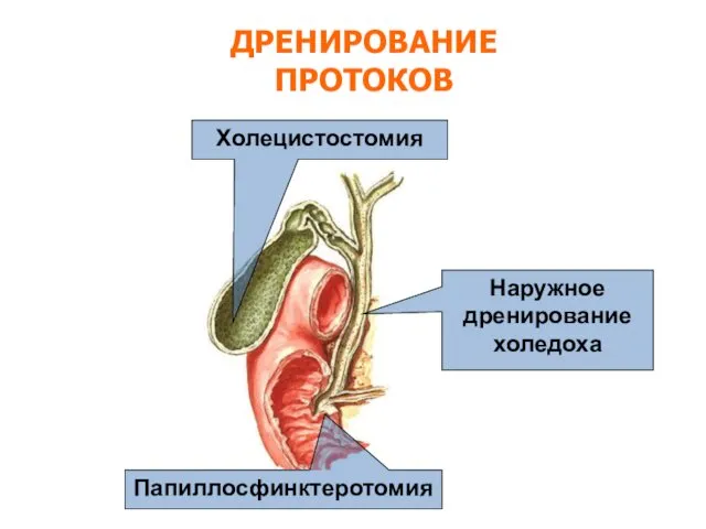 ДРЕНИРОВАНИЕ ПРОТОКОВ Холецистостомия Наружное дренирование холедоха Папиллосфинктеротомия