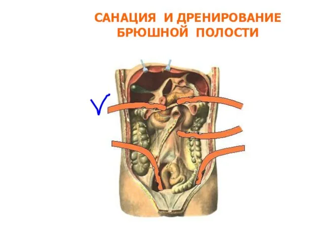 САНАЦИЯ И ДРЕНИРОВАНИЕ БРЮШНОЙ ПОЛОСТИ