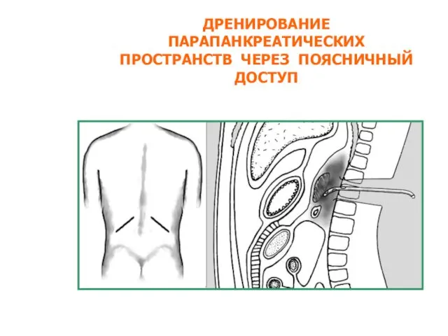 ДРЕНИРОВАНИЕ ПАРАПАНКРЕАТИЧЕСКИХ ПРОСТРАНСТВ ЧЕРЕЗ ПОЯСНИЧНЫЙ ДОСТУП