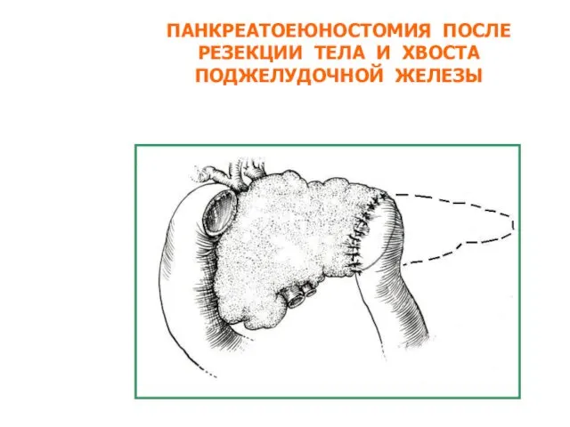 ПАНКРЕАТОЕЮНОСТОМИЯ ПОСЛЕ РЕЗЕКЦИИ ТЕЛА И ХВОСТА ПОДЖЕЛУДОЧНОЙ ЖЕЛЕЗЫ