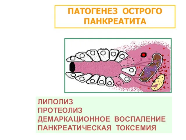 ПАТОГЕНЕЗ ОСТРОГО ПАНКРЕАТИТА ЛИПОЛИЗ ПРОТЕОЛИЗ ДЕМАРКАЦИОННОЕ ВОСПАЛЕНИЕ ПАНКРЕАТИЧЕСКАЯ ТОКСЕМИЯ