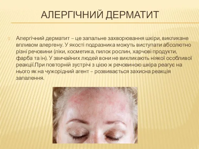 АЛЕРГІЧНИЙ ДЕРМАТИТ Алергічний дерматит – це запальне захворювання шкіри, викликане