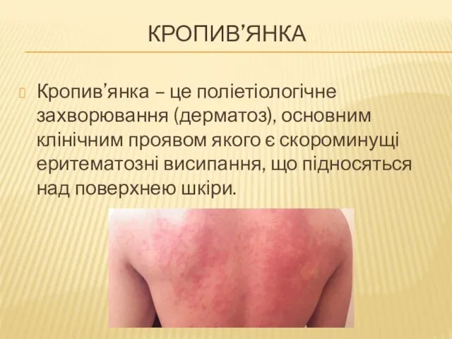 КРОПИВ’ЯНКА Кропив’янка – це поліетіологічне захворювання (дерматоз), основним клінічним проявом