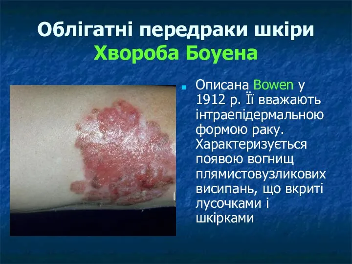 Облігатні передраки шкіри Хвороба Боуена Описана Bowen у 1912 р. Її вважають інтраепідермальною