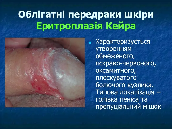 Облігатні передраки шкіри Еритроплазія Кейра Характеризується утворенням обмеженого, яскраво-червоного, оксамитного, плескуватого болючого вузлика.
