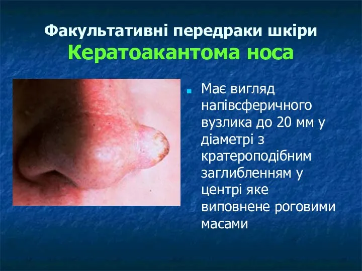 Факультативні передраки шкіри Кератоакантома носа Має вигляд напівсферичного вузлика до