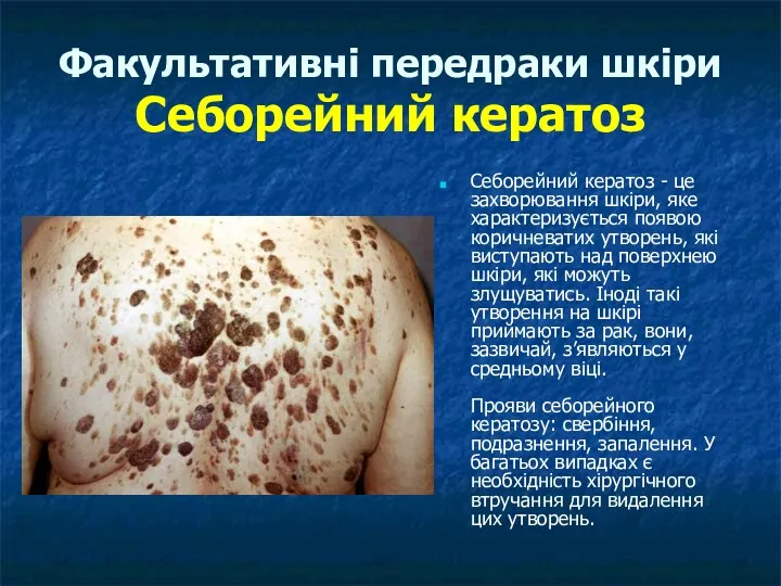 Факультативні передраки шкіри Себорейний кератоз Себорейний кератоз - це захворювання