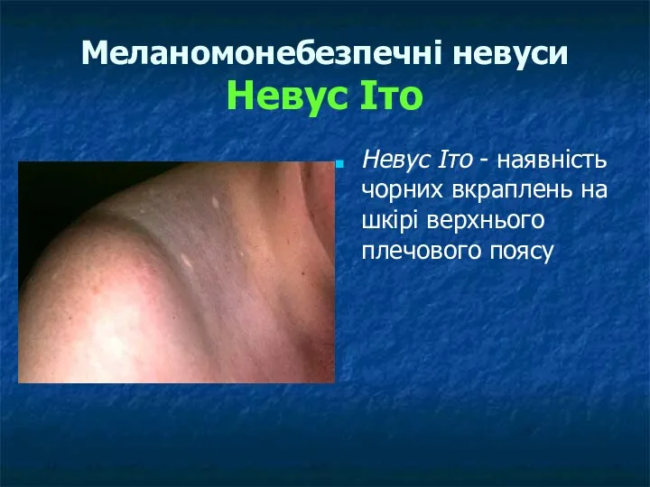 Меланомонебезпечні невуси Невус Іто Невус Іто - наявність чорних вкраплень на шкірі верхнього плечового поясу