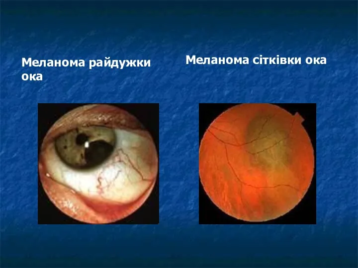 Меланома райдужки ока Меланома сітківки ока