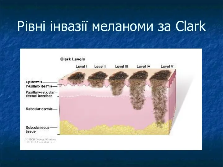 Рівні інвазії меланоми за Clark