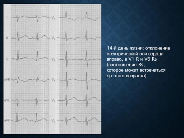 14-й день жизни: отклонение электрической оси сердца вправо, в V1 R и V6