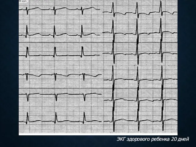 ЭКГ здорового ребенка 20 дней