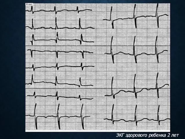 ЭКГ здорового ребенка 2 лет
