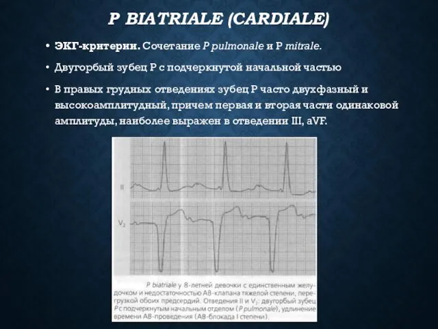 Р BIATRIALE (CARDIALE) ЭКГ-критерии. Сочетание Р pulmonale и Р mitrale. Двугорбый зубец Р
