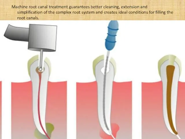 Machine root canal treatment guarantees better cleaning, extension and simplification of the complex