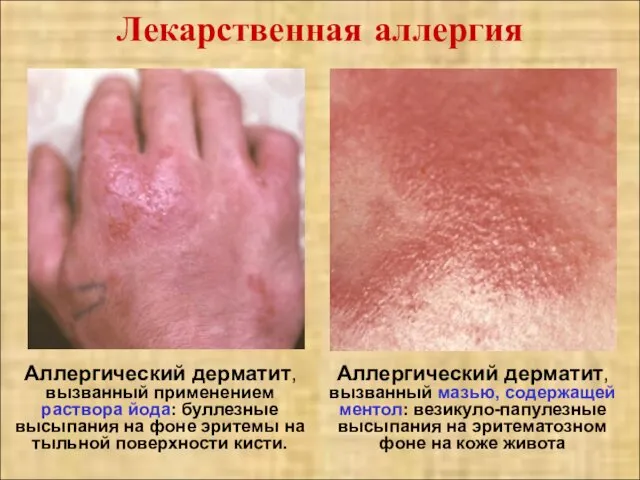 Лекарственная аллергия Аллергический дерматит, вызванный применением раствора йода: буллезные высыпания