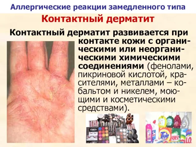 Контактный дерматит Контактный дерматит развивается при контакте кожи с органи-