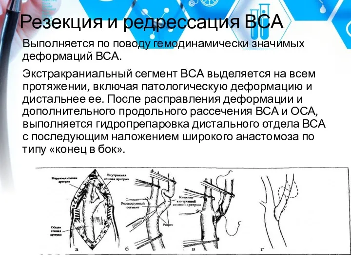 Резекция и редрессация ВСА Выполняется по поводу гемодинамически значимых деформаций