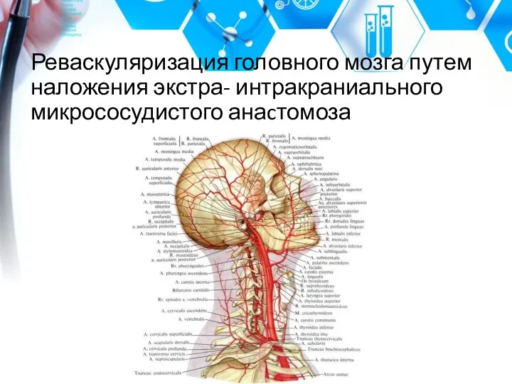 Реваскуляризация головного мозга путем наложения экстра- интракраниального микрососудистого анаcтомоза