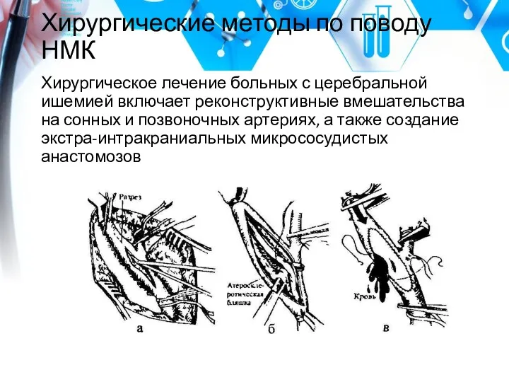 Хирургические методы по поводу НМК Хирургическое лечение больных с церебральной