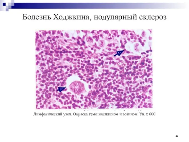 Болезнь Ходжкина, нодулярный склероз Типичные клетки Березовского – Штернберга – Рид. Лимфатический узел.