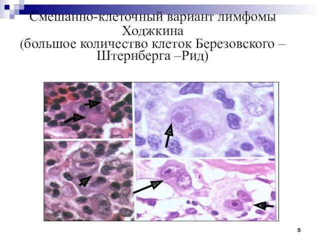 Смешанно-клеточный вариант лимфомы Ходжкина (большое количество клеток Березовского – Штернберга –Рид)