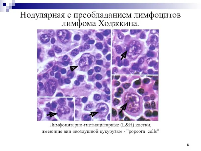 Нодулярная с преобладанием лимфоцитов лимфома Ходжкина. Лимфоцитарно-гистиоцитарные (L&H) клетки, имеющие вид «воздушной кукурузы» - ”pоpcorn сells”