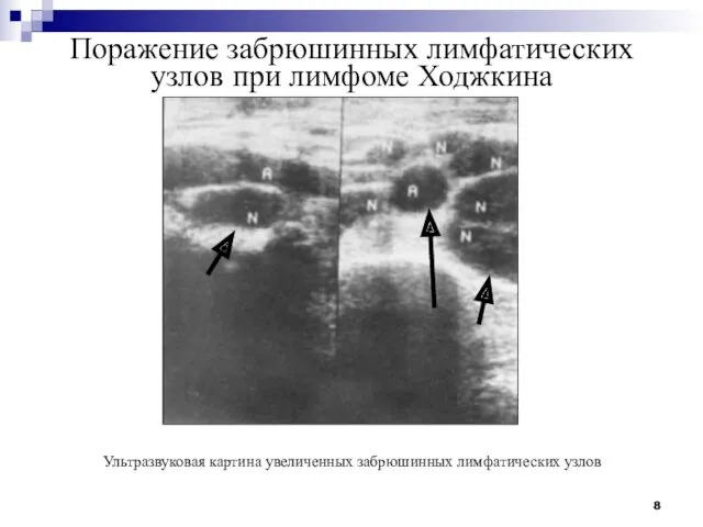 Поражение забрюшинных лимфатических узлов при лимфоме Ходжкина Ультразвуковая картина увеличенных забрюшинных лимфатических узлов