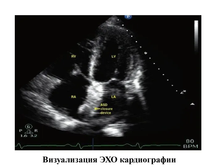 Визуализация ЭХО кардиографии