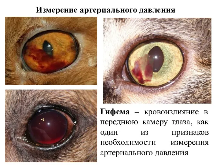 Измерение артериального давления Гифема – кровоизлияние в переднюю камеру глаза,