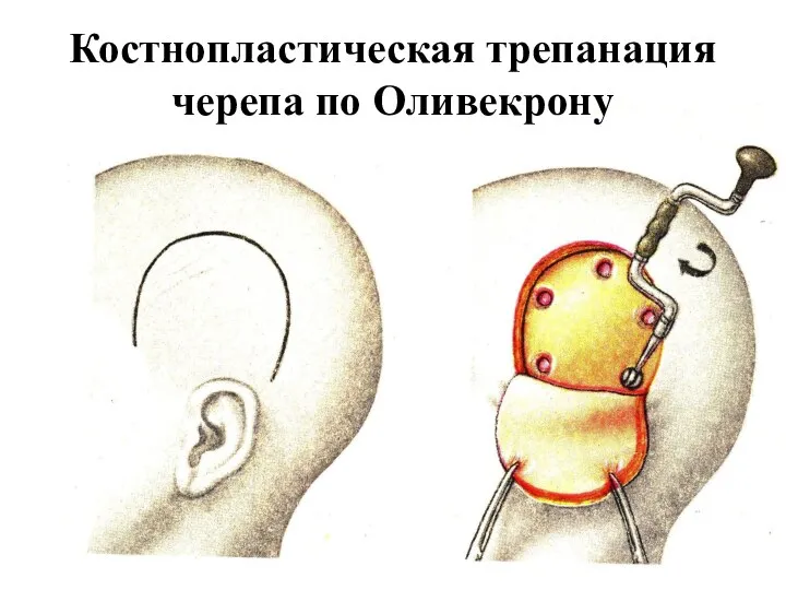 Костнопластическая трепанация черепа по Оливекрону