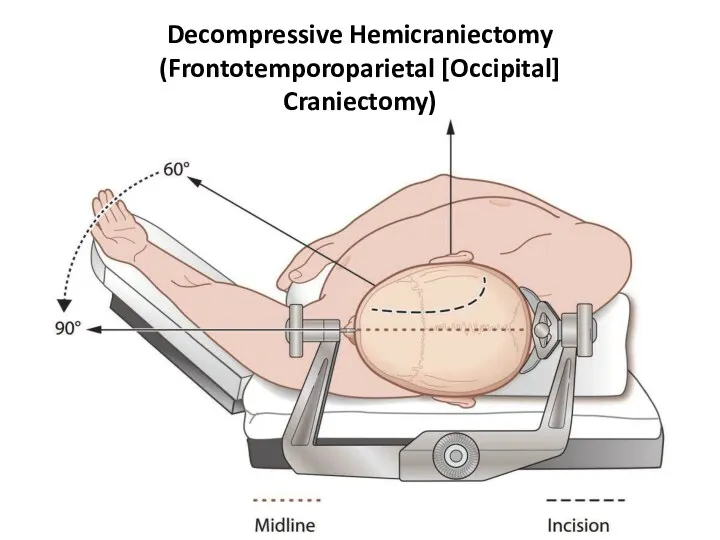 Decompressive Hemicraniectomy (Frontotemporoparietal [Occipital] Craniectomy)