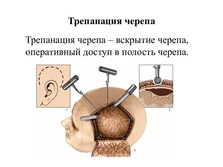 Трепанация черепа Трепанация черепа – вскрытие черепа, оперативный доступ в полость черепа.