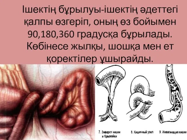 Ішектің бұрылуы-ішектің әдеттегі қалпы өзгеріп, оның өз бойымен 90,180,360 градусқа