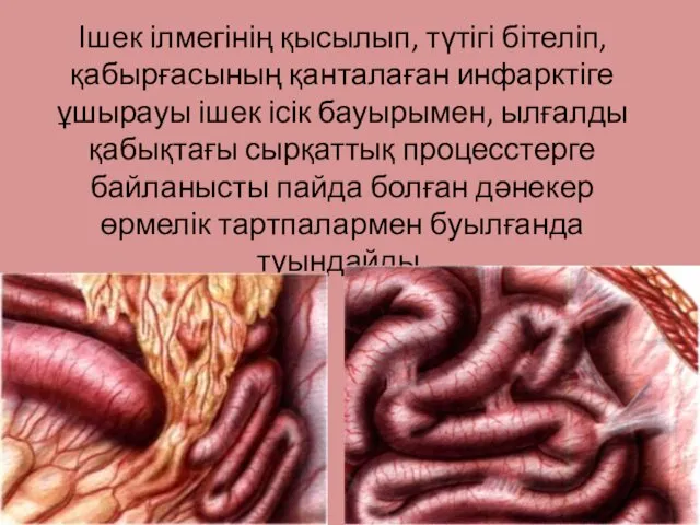 Ішек ілмегінің қысылып, түтігі бітеліп, қабырғасының қанталаған инфарктіге ұшырауы ішек