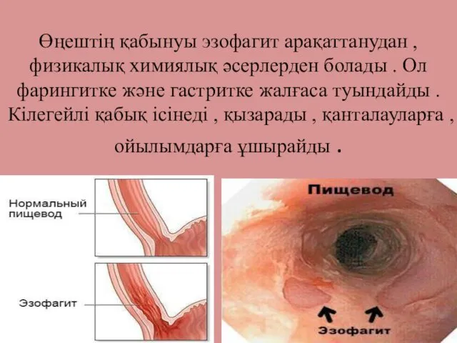 Өңештің қабынуы эзофагит арақаттанудан , физикалық химиялық әсерлерден болады .