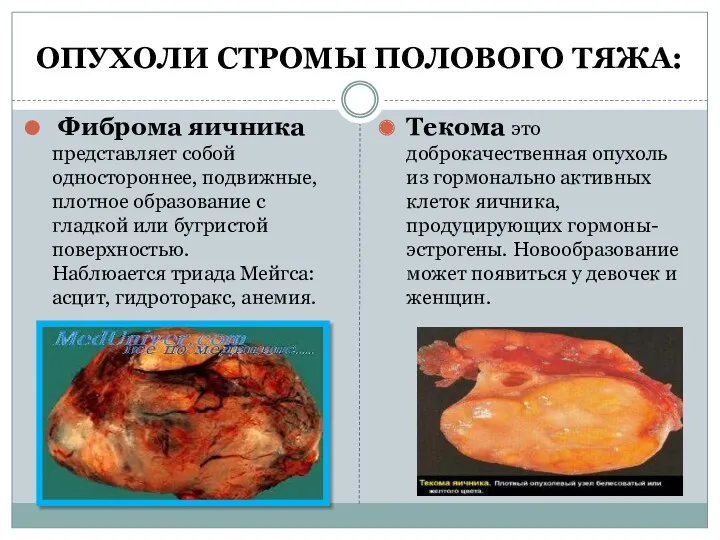 ОПУХОЛИ СТРОМЫ ПОЛОВОГО ТЯЖА: Фиброма яичника представляет собой одностороннее, подвижные, плотное образование с