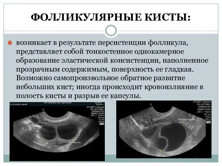 ФОЛЛИКУЛЯРНЫЕ КИСТЫ: возникает в результате персистенции фолликула, представляет собой тонкостенное