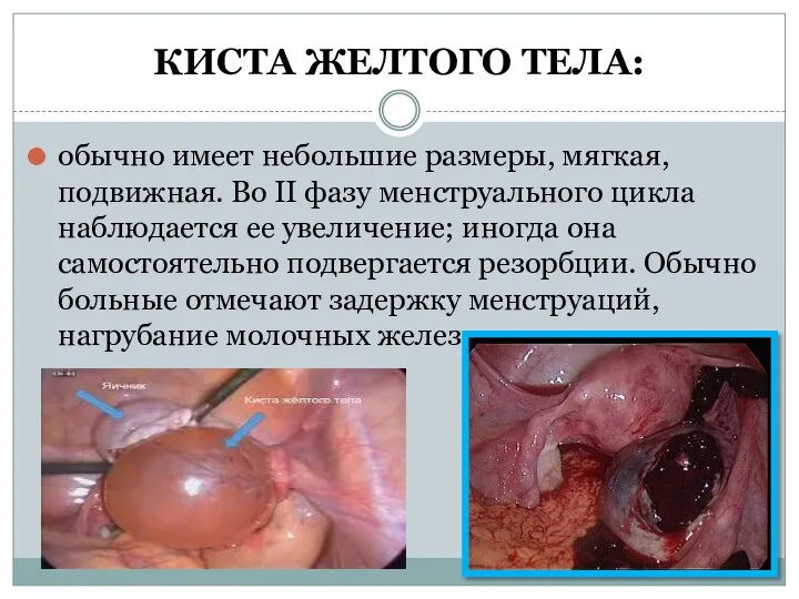 КИСТА ЖЕЛТОГО ТЕЛА: обычно имеет небольшие размеры, мягкая, подвижная. Во