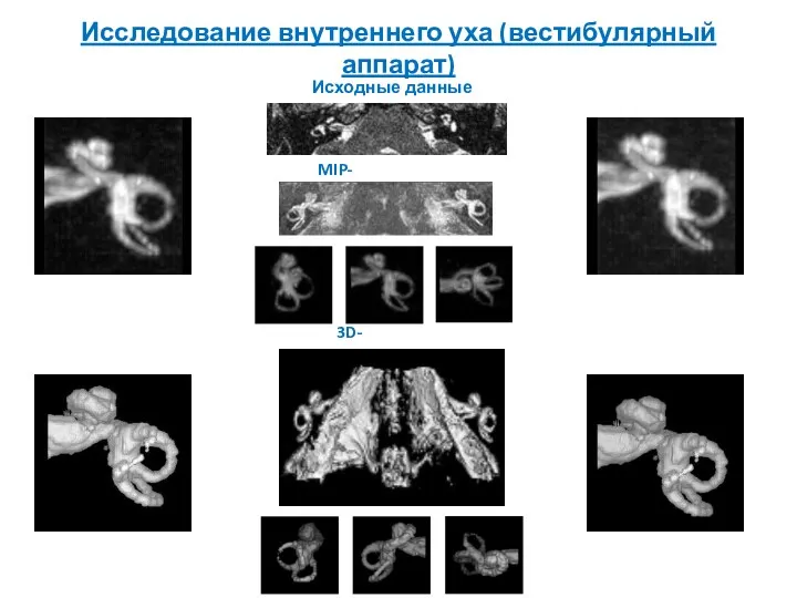 MIP-реконструкция 3D-рендеринг Исходные данные Исследование внутреннего уха (вестибулярный аппарат)